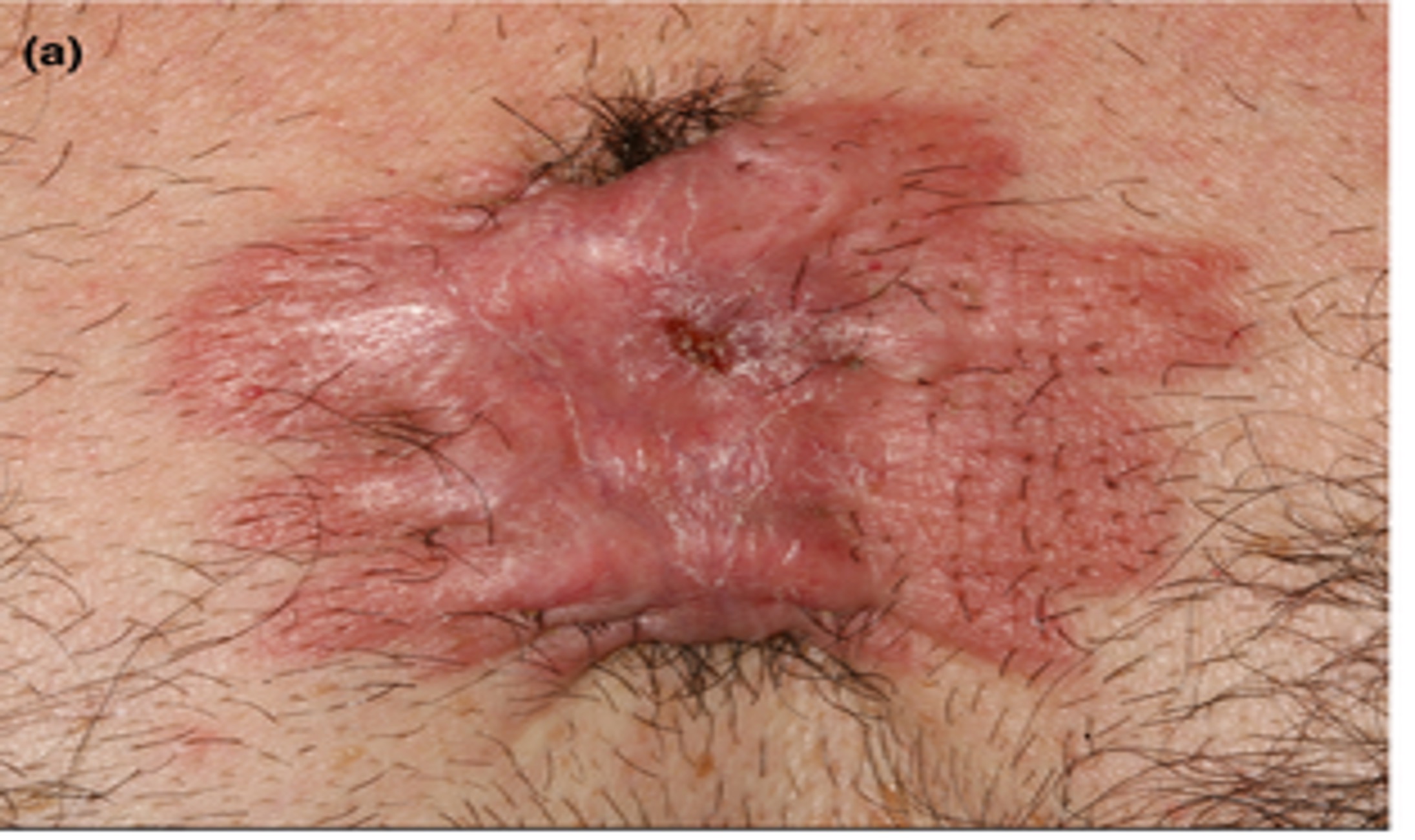 化脓性瘢痕疙瘩：严重瘢痕疙瘩病的一种并发症