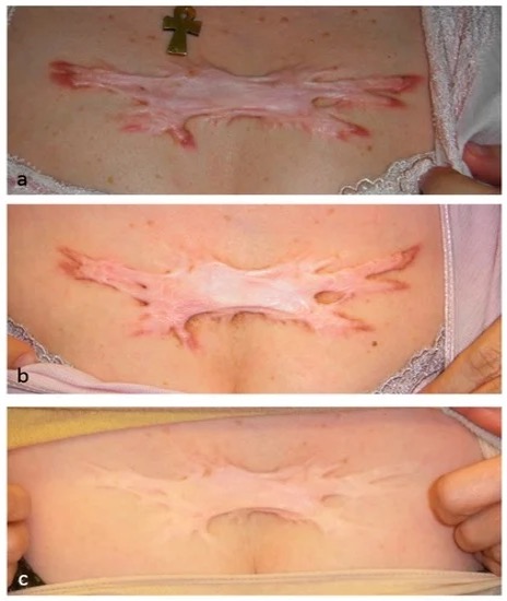 瘢痕疙瘩组织的病理学和基因分析