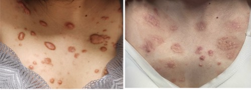 网状多面体内注射治疗瘢痕疙瘩