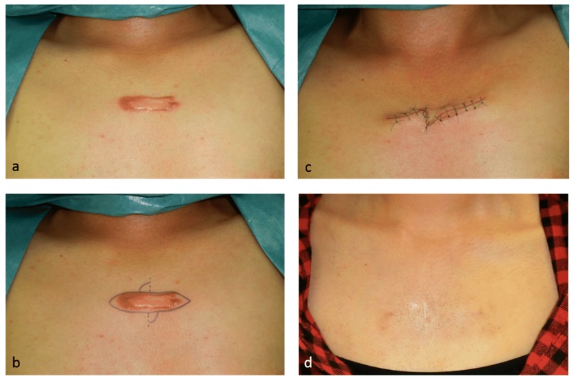 瘢痕疙瘩的中央区域会发生的严重缺血