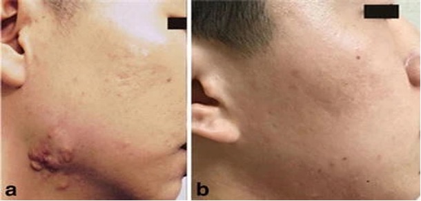 瘢痕疙瘩治疗中的副作用可能性