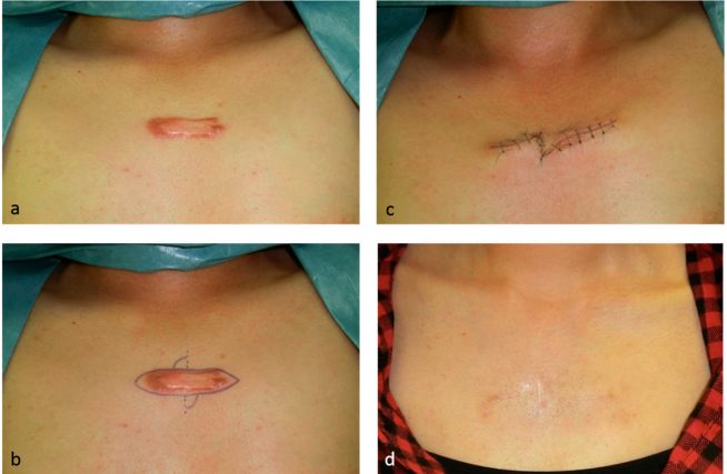 瘢痕疙瘩和增生性瘢痕是网状真皮慢性炎症的结果