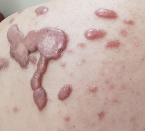 瘢痕疙瘩的新靶点和治疗方法综述