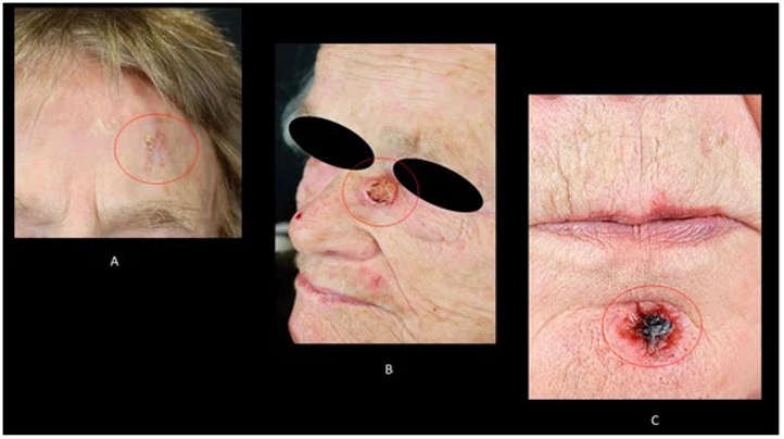 非黑色素瘤皮肤癌——皮肤鳞状细胞癌