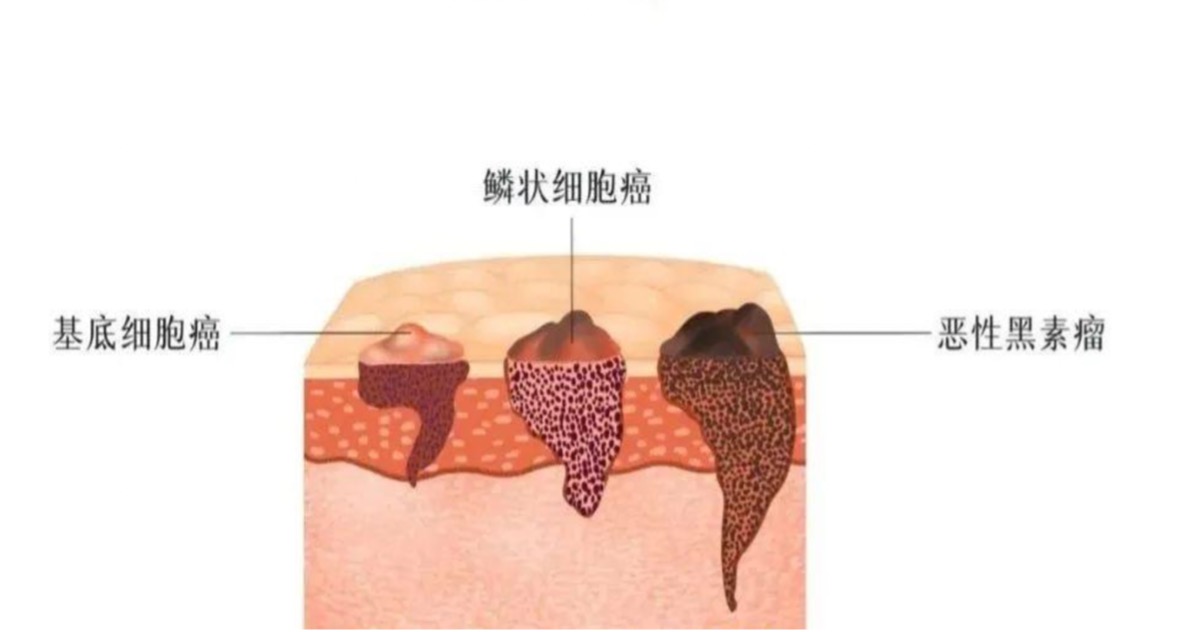 肾移植患者皮肤鳞状细胞癌的风险