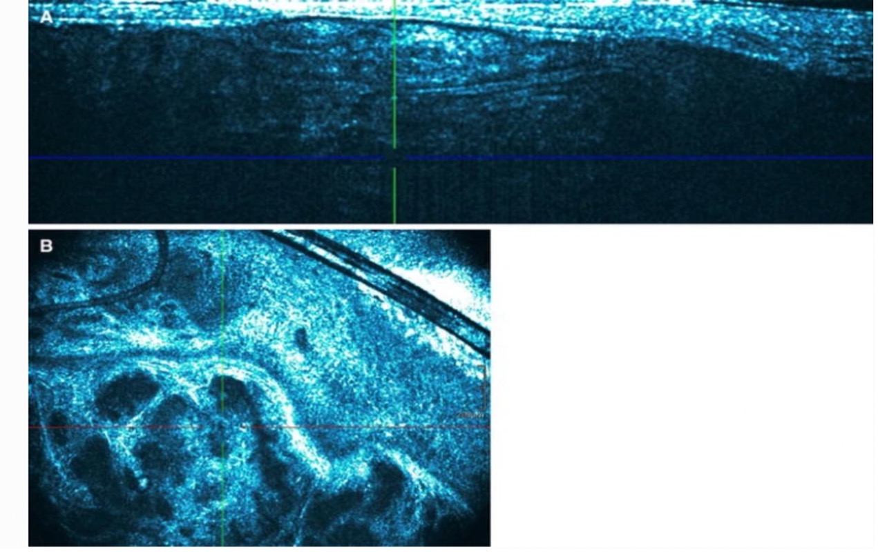 诊断非黑色素瘤细胞癌中基底细胞癌（BCC）的方法——光学相干断层扫描