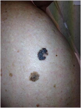 肥胖是恶性黑色素瘤和非黑色素瘤皮肤癌的危险因素