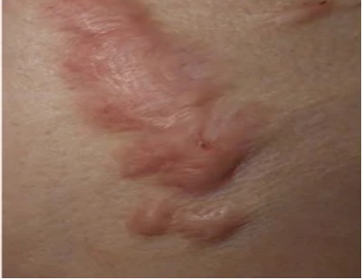 瘢痕疙瘩症中 ASPN 与 ECM 行为之间的关系