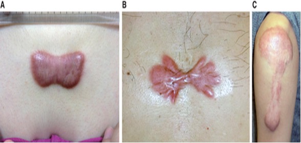 瘢痕疙瘩的硬度间隙差距