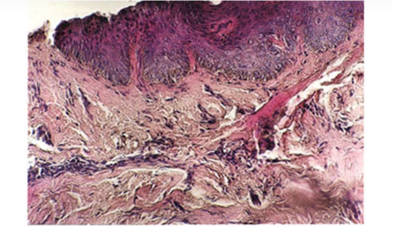 瘢痕内冷冻疗法（IL）