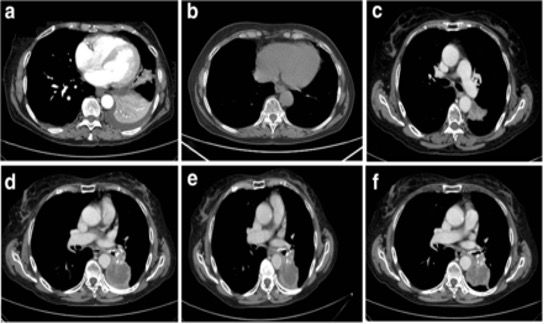 ICI免疫疗法：治疗基底细胞癌
