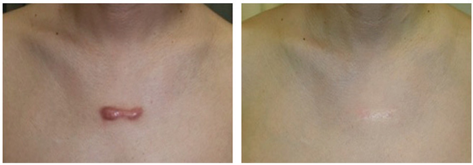 类固醇胶带：疤痕管理的辅助剂