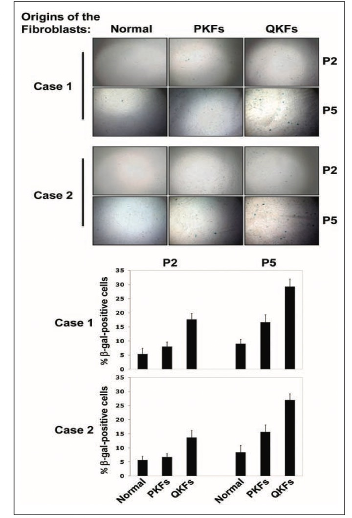 细胞衰老是阻止瘢痕疙瘩恶化的可能机制