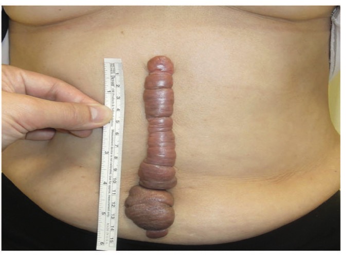 自体脂肪移植治疗瘢痕疙瘩和增生性疤痕