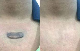 注射曲安奈德和5-氟尿嘧啶治疗瘢痕疙瘩后的锶-90近距离放射治疗