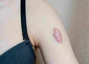 瘢痕疙瘩增生调节机制