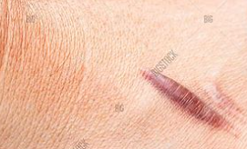 瘢痕疙瘩——临床诊断、发病机制和治疗选择