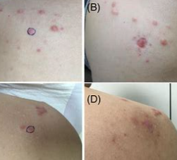 瘢痕疙瘩手术治疗的辅助疗法